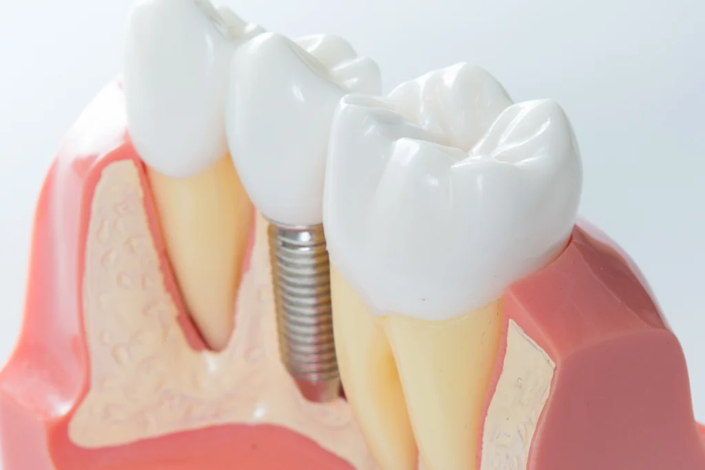 Implant dentaire à Lille pour remplacer une dent manquante